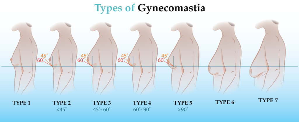 Image of several types of gynecomastia in males ranging from type 1 to type 7