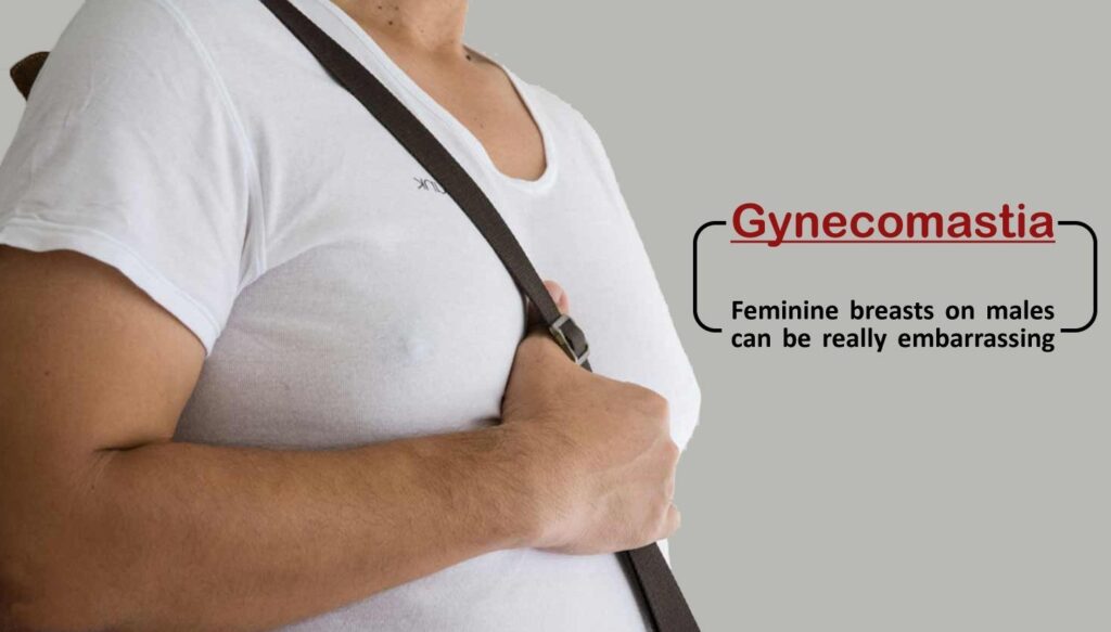 Image of a man with gynecomastia in a tee shirt with a capture that reads: Gynecomastia: Feminine breasts on males can be really embarrassing.
